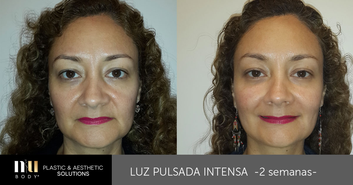 Rejuvenecimiento Facial: Luz Pulsada IPL- Oftalvist