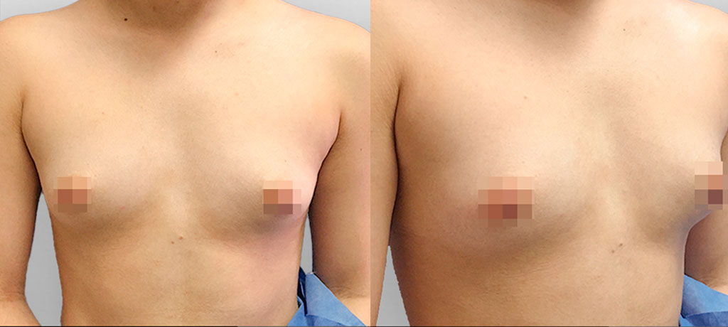 breast augmentation in mexico