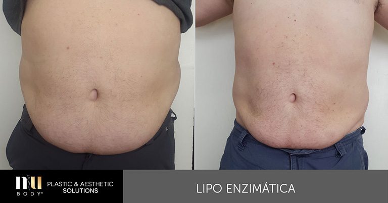 qu-es-la-lipo-enzim-tica-y-c-mo-funciona-nubody
