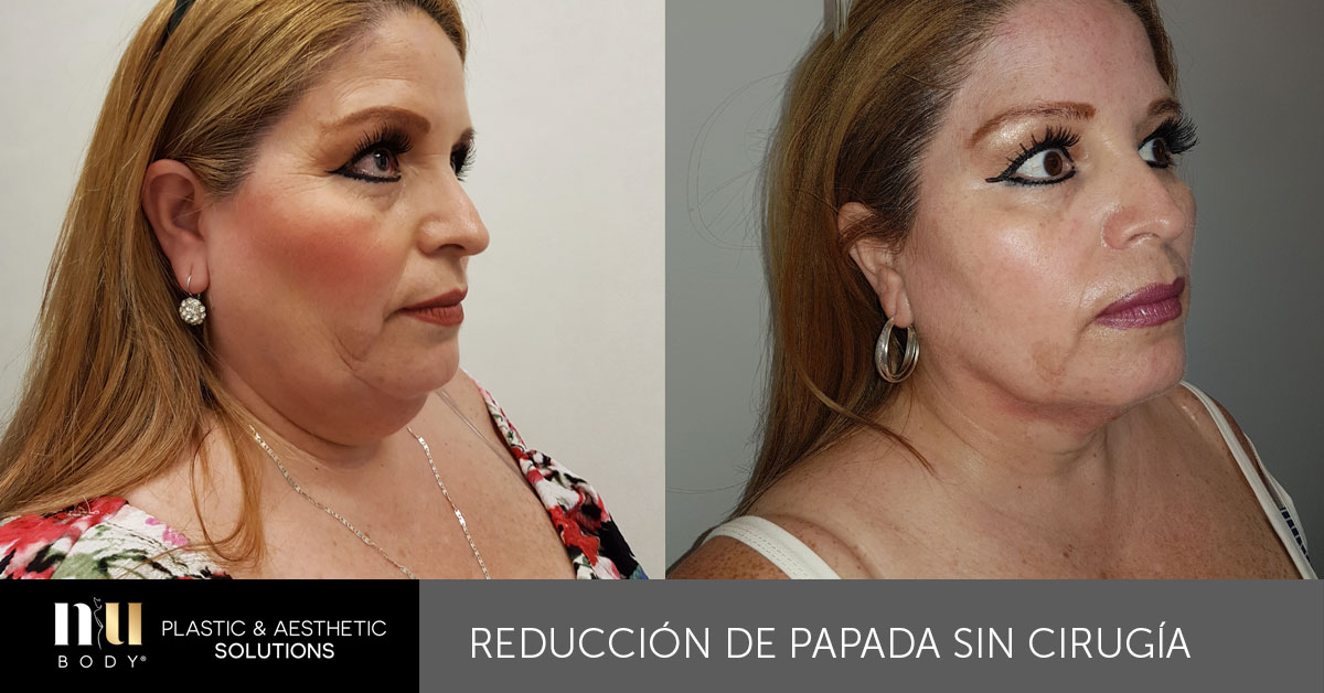 Lipo Enzimática nuBODY